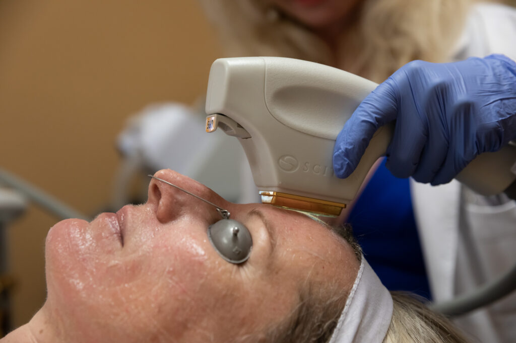 A patient receiving a ForeverClear BBL skin treatment in Indianapolis. She is wrapped in a towel and has protective goggles on as the provider gently glides the handpiece over her skin.