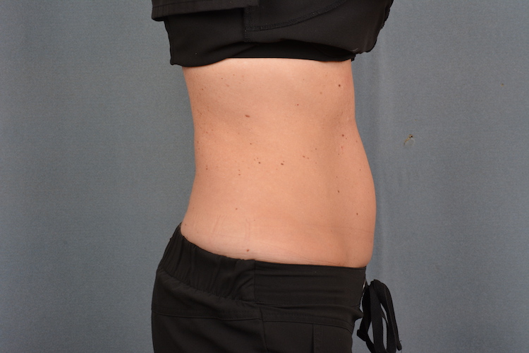 A client's flatter stomach after CoolSculpting, a nonsurgical fat reduction alternative to a tummy tuck in Indiana.