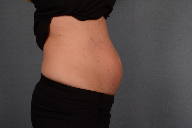 A client's abdomen prior to CoolSculpting, a nonsurgical alternative to a tummy tuck in Indiana.