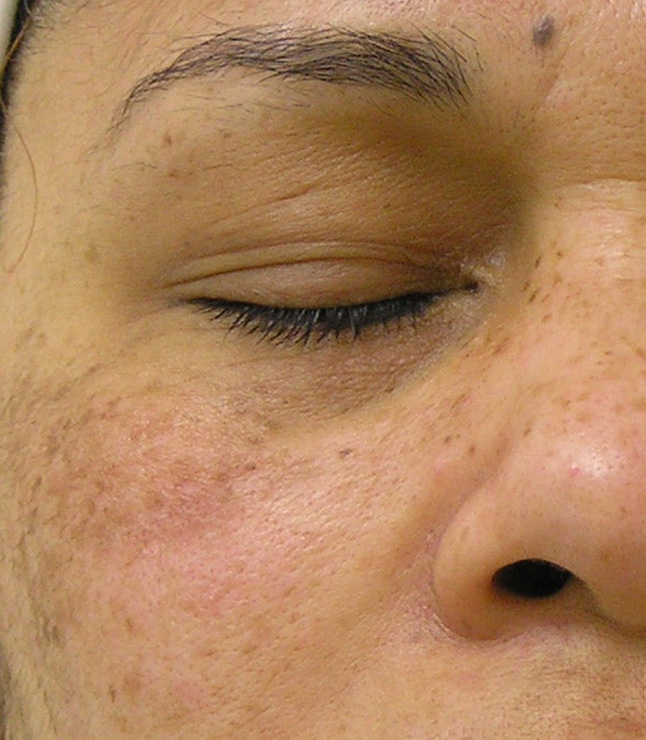 A patient's rejuvenated midface after a series of Hydrafacials near Fishers.