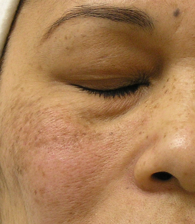 : A patient experiences skin laxity, hyperpigmentation, and fine lines prior to her Hydrafacial near Fishers.