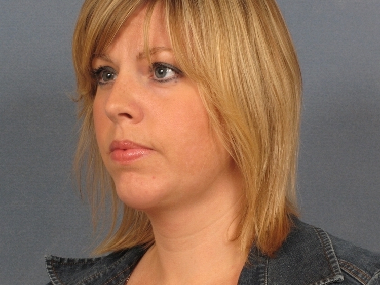 A patient's sculpted, defined jawline after chin fat removal in Indianapolis.