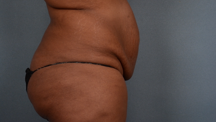 A patient's abdomen prior to her tummy tuck in Indiana.