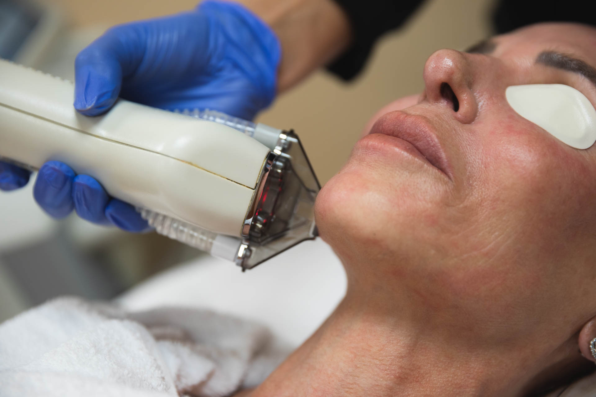 A provider uses the HALO TRIBRID laser for targeted skin tightening in Indiana.