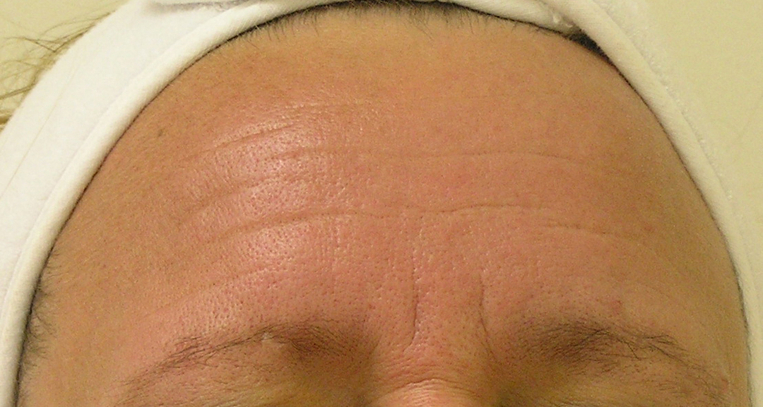 The wrinkles on a patient's forehead are much finer and less noticeable after a series of Hydrafacials near Noblesville.