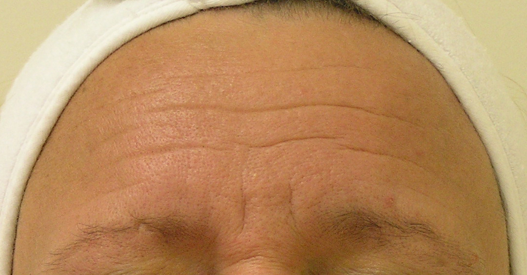 A patient's lined forehead prior to her Hydrafacial near Noblesville.