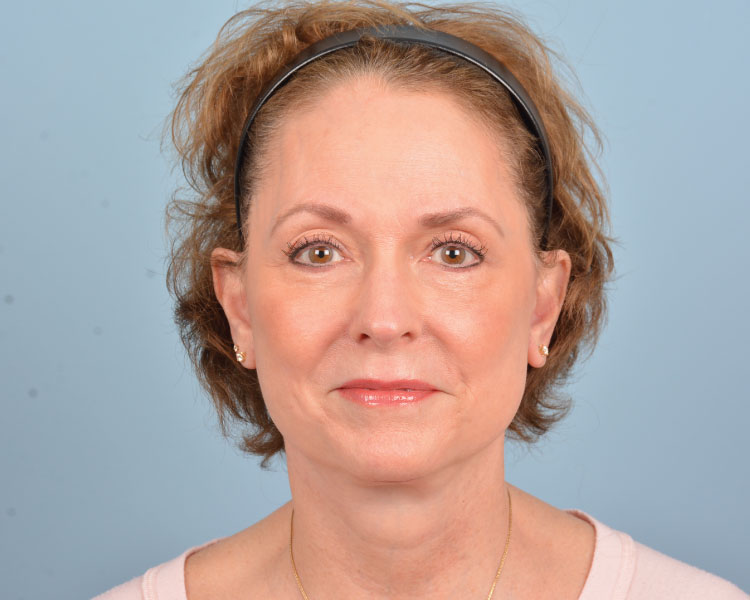 A patient's refined results after receiving a facelift in Indiana.