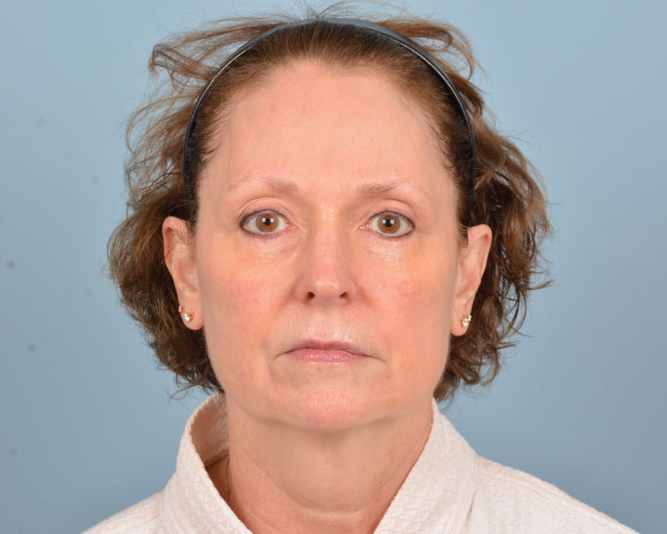 A patient's visage before her facelift in Indiana.