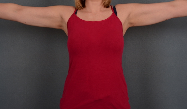 Woman in tank top in an image after an arm lift.