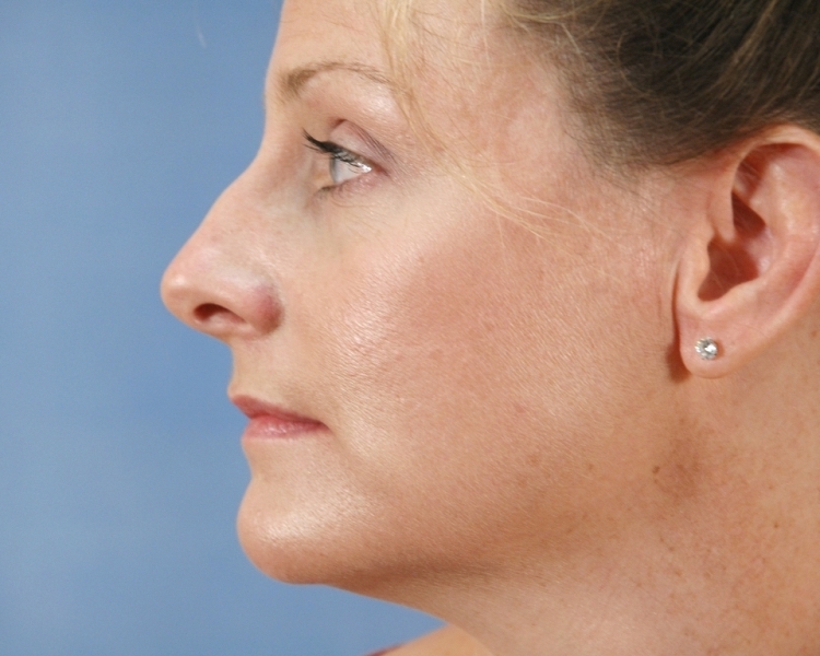 A patient's nose features a small bump at the bridge prior to surgical nose reshaping in Indiana.