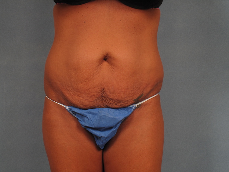 The loose skin around the patient's abdomen sags before her surgical skin tightening in Indiana.