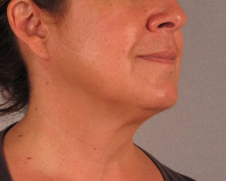 A picture of a female patient's lower face and neck after undergoing skin tightening post-weight loss.
