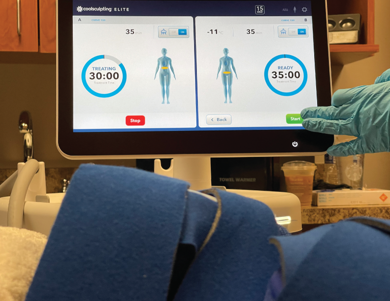A provider prepares the system settings for CoolSculpting near Fishers.