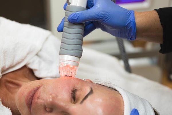 An aesthetician applies the Vivace RF microneedling device during facial skin tightening in Indiana.