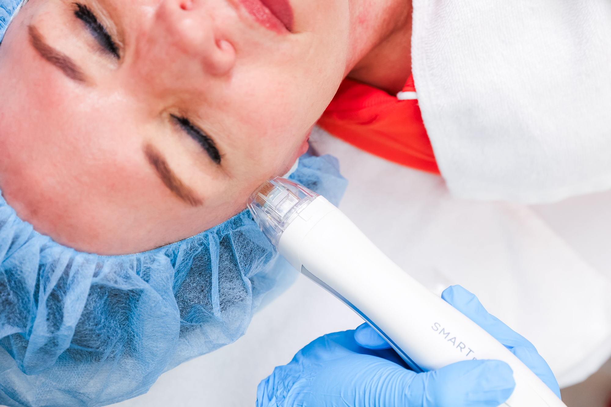A provider applies the handpiece to the upper face during a patient's RF microneedling near Westfield.