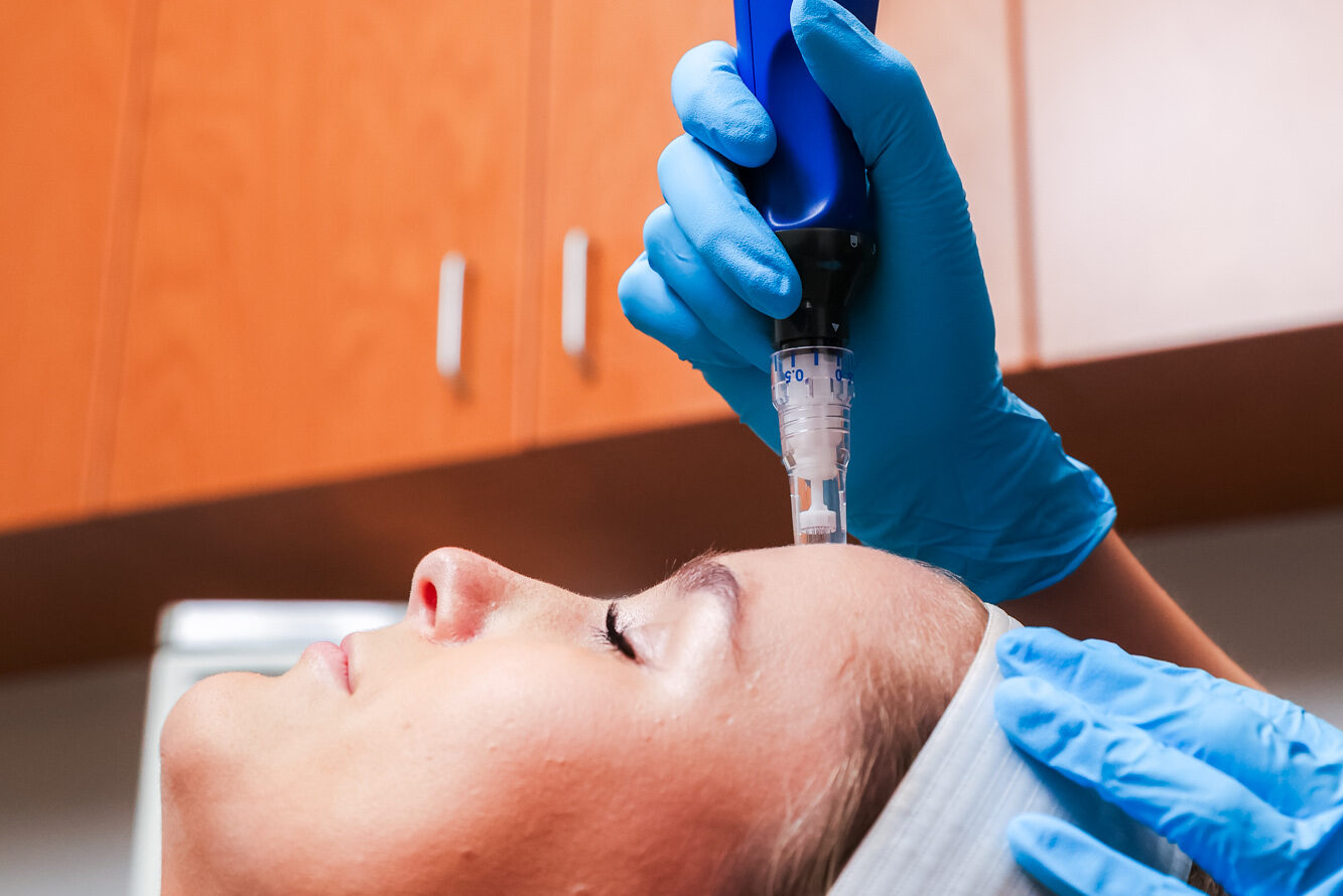 An expert provider passes the SkinPen device across a patient's forehead during microneedling in Carmel.
