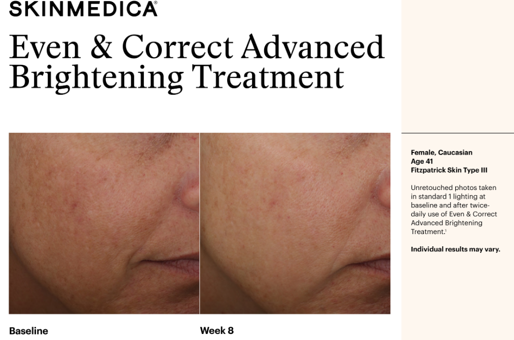 Before and after results of SKINMEDICA Advanced Brightening treatment. The first photo shows more redness on the patient's skin.